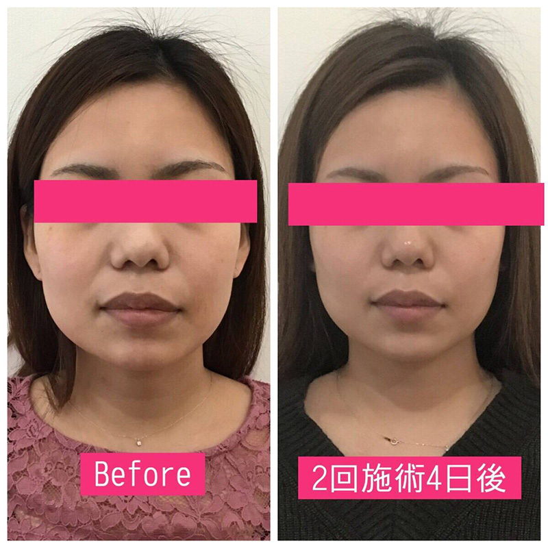 小顔フェイシャル